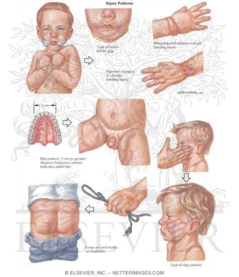 Watermarked preview of labeled image: Child Abuse: Injury Patterns
