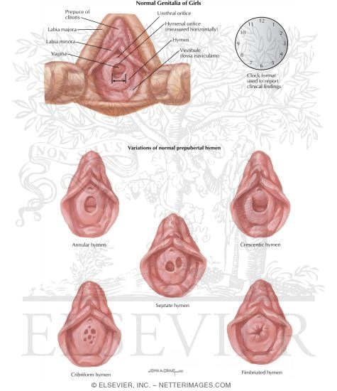 hymen child Figure 1 from A normal ano-genital exam: sexual abuse or not? | Semantic  Scholar