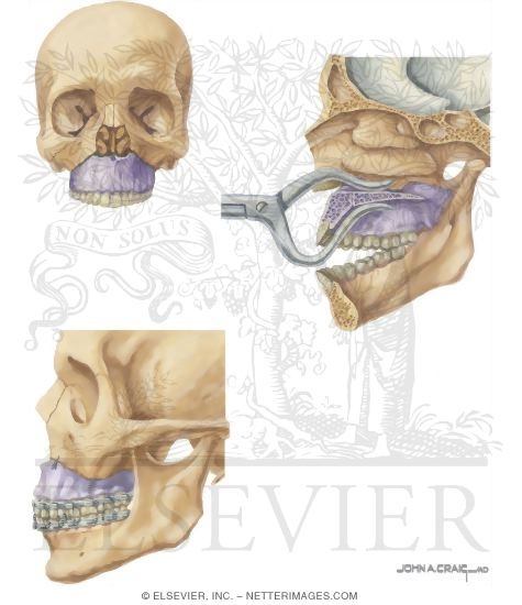 Watermarked preview of unlabeled image: Facial Trauma: Repair of Le Fort I Fracture
