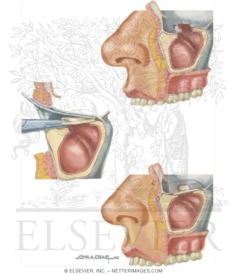 Watermarked preview of unlabeled image: Facial Trauma: Repair of Blow Out Fracture