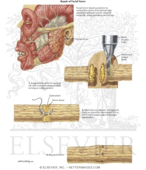 Watermarked preview of labeled image: Facial Trauma: Repair of Facial Nerve