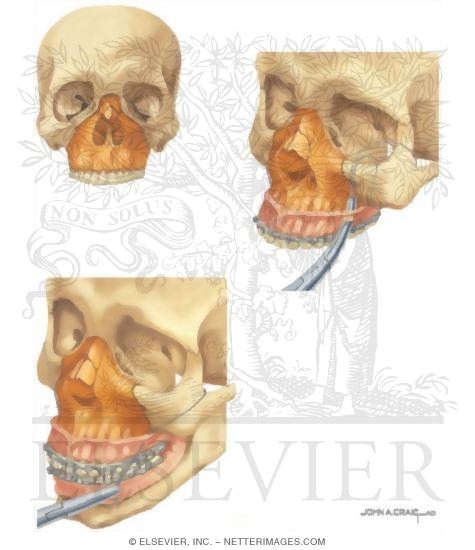 Facial Trauma: Repair of Le Fort II Pyramidal Fracture