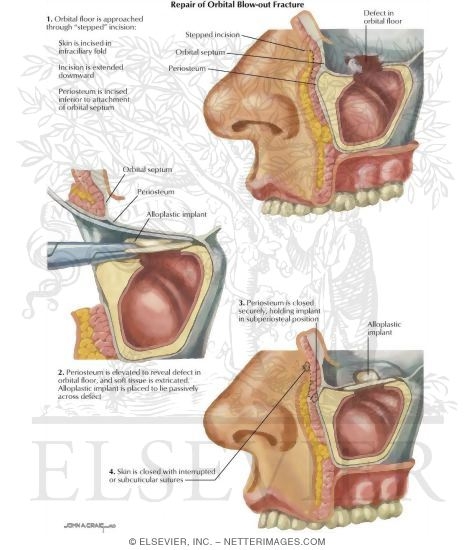 Facial Trauma: Repair of Blow Out Fracture