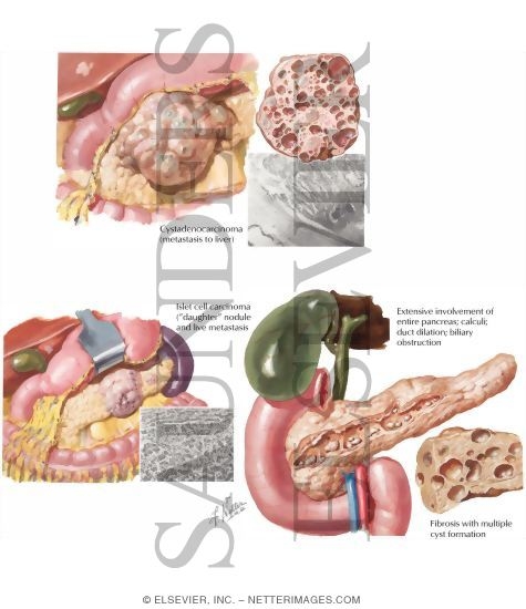 Chronic pancreatitis thesis picture