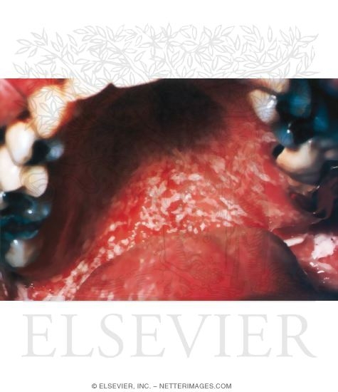 Pseudomembranous Candidiasis of the Palate