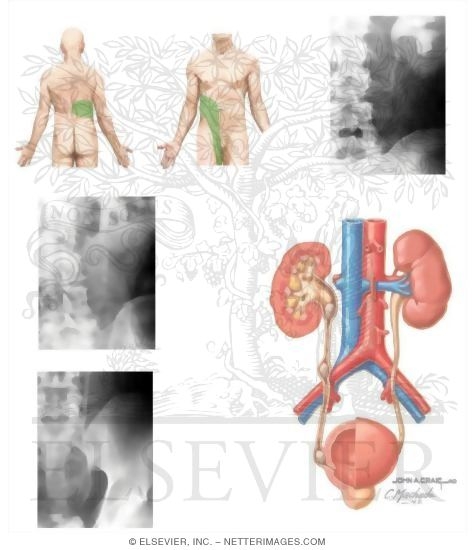 Watermarked preview of unlabeled image: Calculous Urinary Obstruction