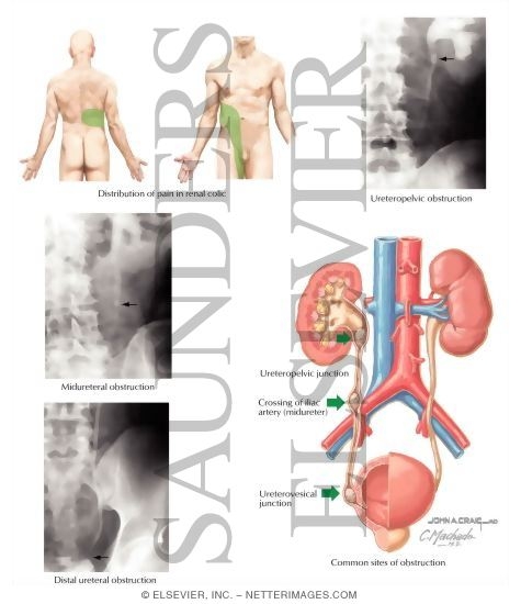 Watermarked preview of labeled image: Calculous Urinary Obstruction
