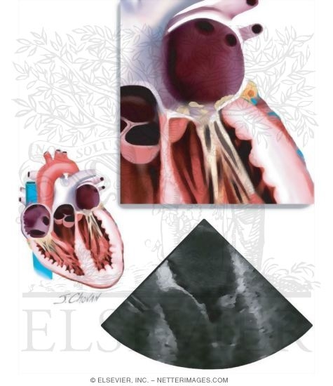Libman-Sacks Endocarditis