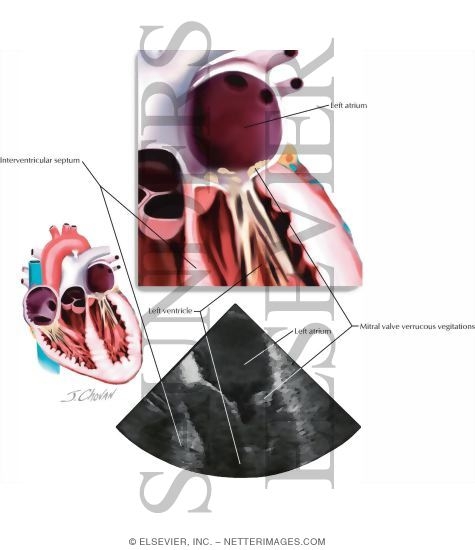 Libman-Sacks Endocarditis