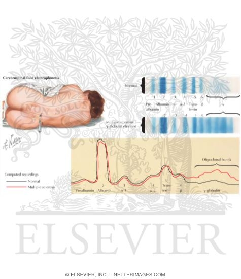 Watermarked preview of labeled image: Multiple Sclerosis: Diagnostic Tests - Spinal Fluid