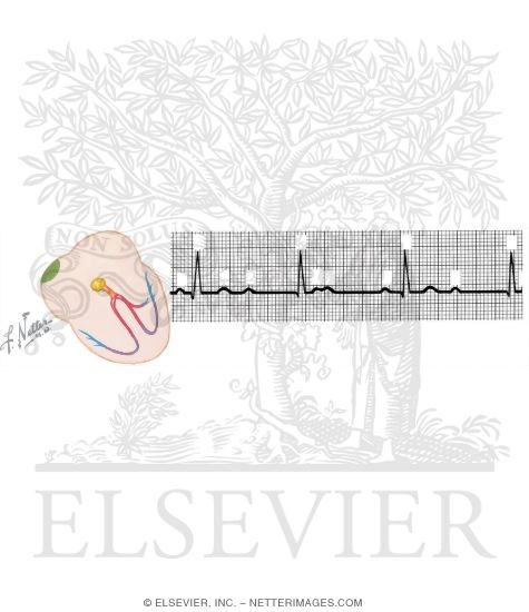 Watermarked preview of unlabeled image: Atrioventricular Block