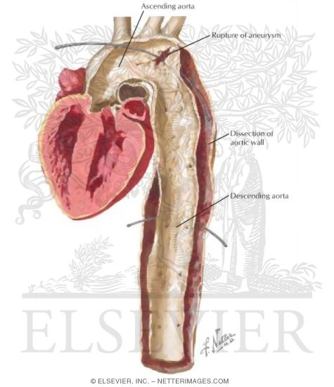 Watermarked preview of labeled image: Aortic Aneurysm