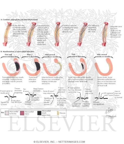 Watermarked preview of labeled image: Myocardial Ischemia