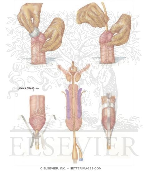 Watermarked preview of unlabeled image: Nosocomial Infections: Technique of Urethral Catheterization In the Male