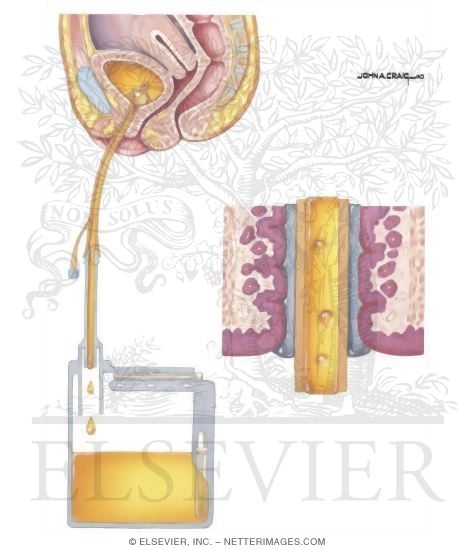 Nosocomial Infections: Sepsis Associated With Indwelling Urinary Catheters