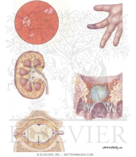 Systemic candidiasis outlet