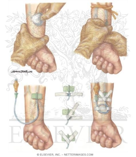 Watermarked preview of unlabeled image: Nosocomial Infections: Technique of Intravenous Line Introduction