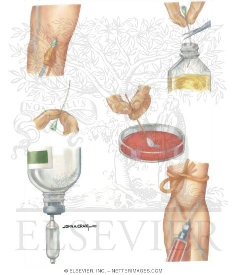 Watermarked preview of unlabeled image: Nosocomial Infections: Diagnosis of Sepsis Associated With Intravenous Fluid Administration