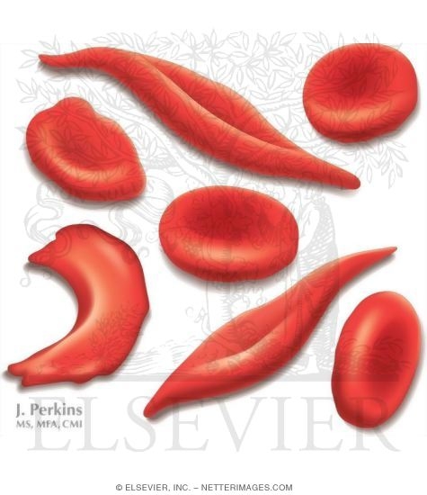 Watermarked preview of unlabeled image: Sickled Red Blood Cells