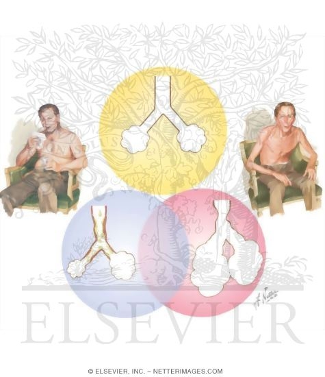 Watermarked preview of unlabeled image: Interrelationship of Chronic Bronchitis and Emphysema