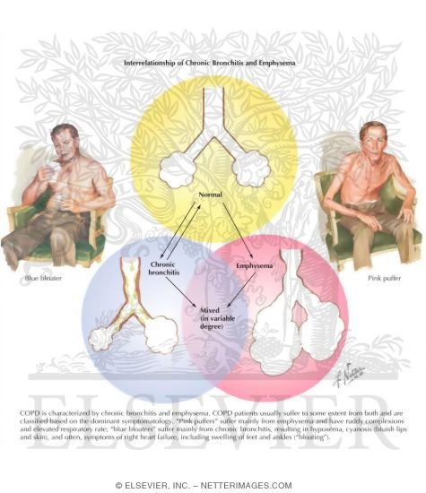 Watermarked preview of labeled image: Interrelationship of Chronic Bronchitis and Emphysema