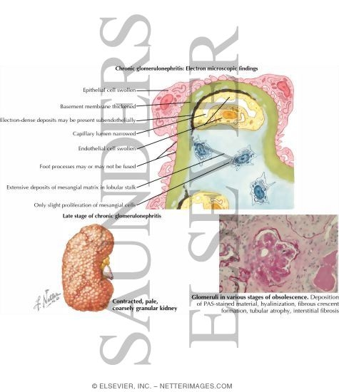 Chronic Glomerulonephritis