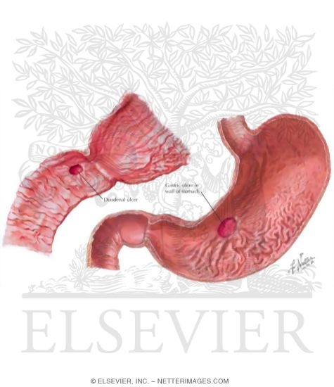 Watermarked preview of labeled image: Ulcerations of Stomach and Duodenum