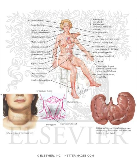 Clinical Symptoms of Hyperthyroidism