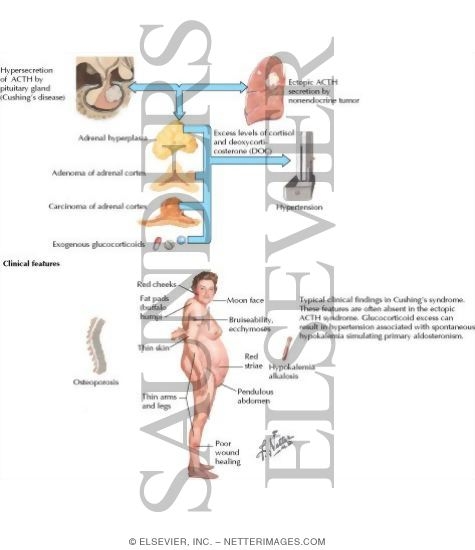 Watermarked preview of labeled image: Cushing's Syndrome