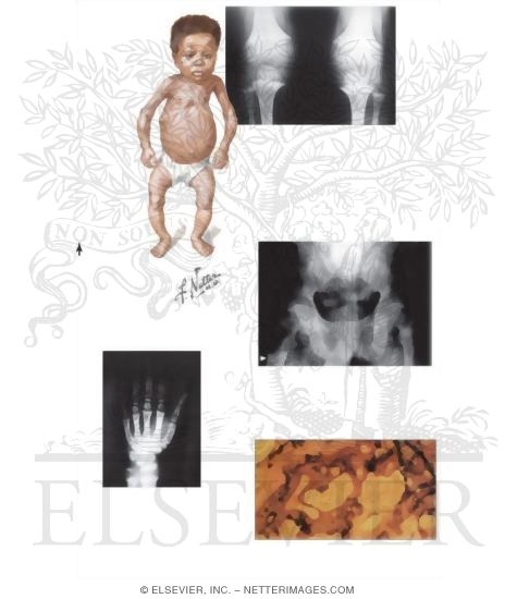 Clinical Manifestations of Rickets in Childhood