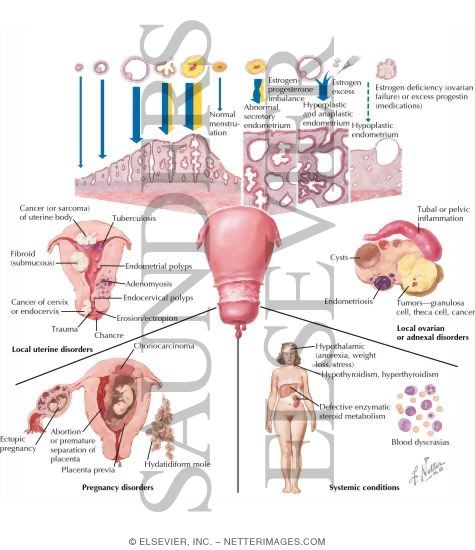 Watermarked preview of labeled image: Functional and Pathological Causes of Uterine Bleeding
Dysfunctional Uterine Bleeding