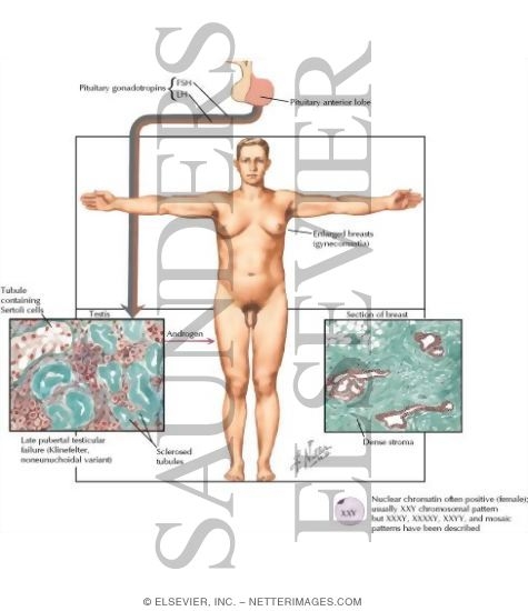 Watermarked preview of labeled image: Testicular Failure - Seminiferous Tubular Dysgenesis (Klinefelter's Syndrome)