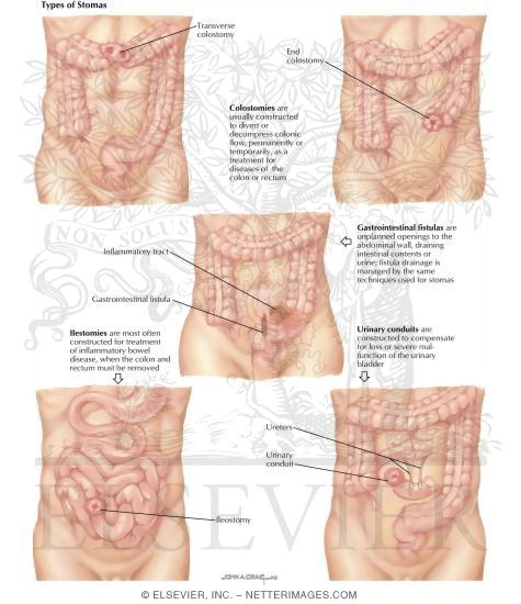 Types of Stomas