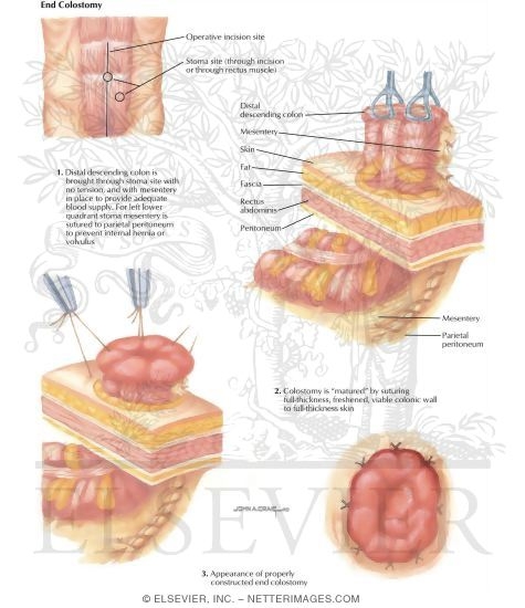 Types of Stomas: End Colostomy
