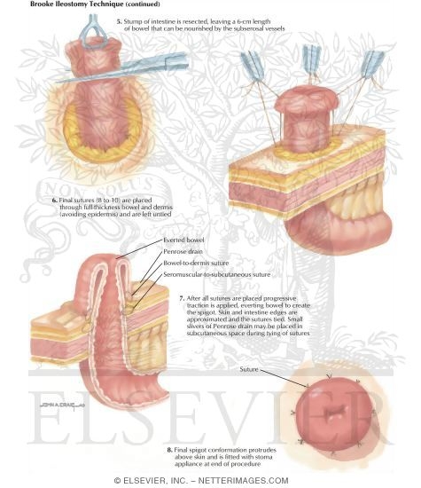 Types of Stomas: Brooke Ileostomy Technique