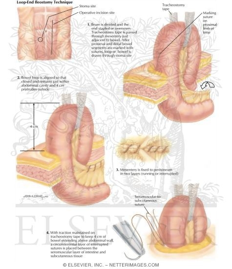 Types of Stomas: Loop and Ileostomy Technique