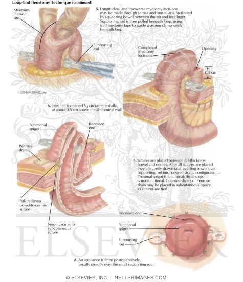 Watermarked preview of labeled image: Types of Stomas: Loop and Ileostomy Technique