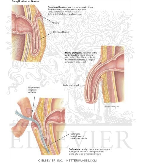 Watermarked preview of labeled image: Types of Stomas: Complications