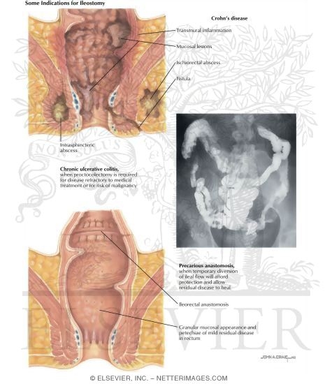Types of Stomas: Some Indication for an Ileostomy
