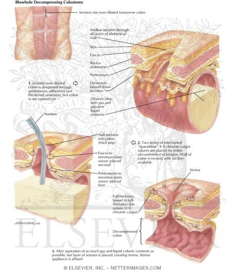 Watermarked preview of labeled image: Types of Stomas: Blowhole Decompressing Colostomy