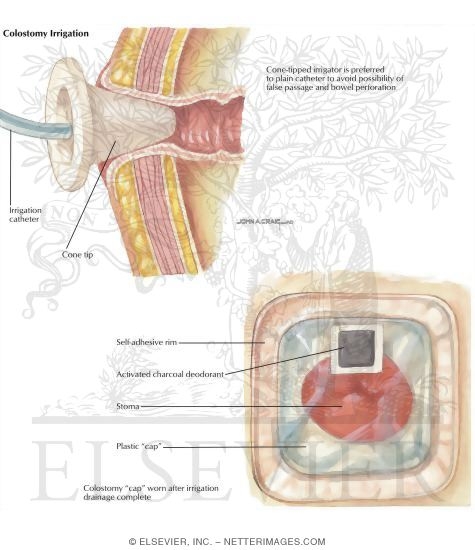 Types of Stomas: Colostomy Irrigation