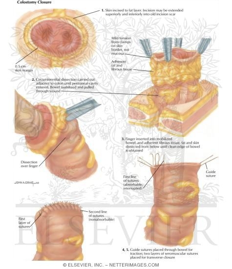 Types of Stomas: Colostomy Closures