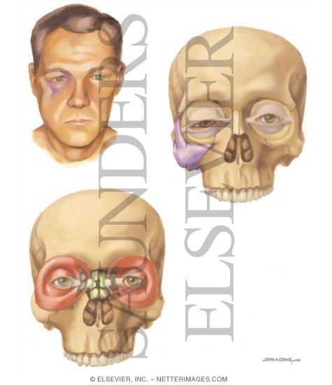 Watermarked preview of unlabeled image: Facial Trauma: Clinical Findings In Zygomatic and Naso-Orbital Injuries