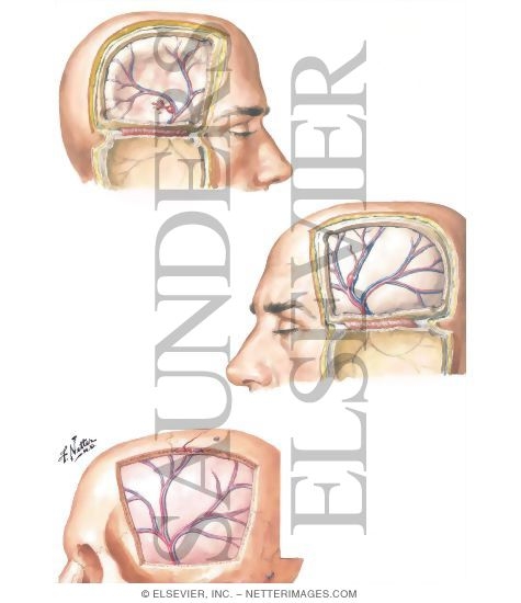 Watermarked preview of unlabeled image: Traumatic Aneurysms of Meningeal Arteries