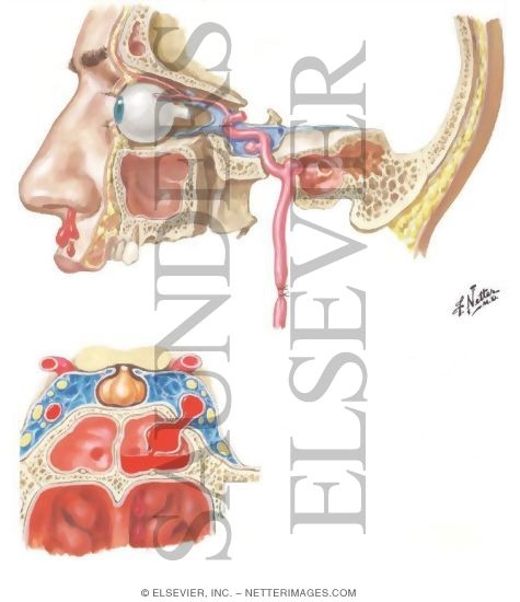 Watermarked preview of unlabeled image: Traumatic Aneurysms of Carotid Artery As It Transverses the Skull
