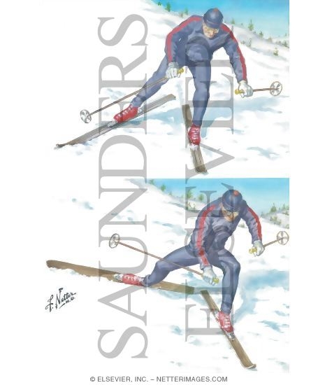 Watermarked preview of unlabeled image: Mechanism of Abduction-External Rotation Ski Injury