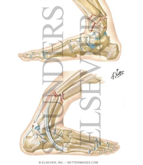 Watermarked preview of unlabeled image: Boot-Top Fractures