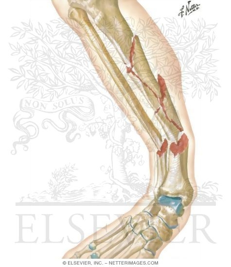 Comminuted Boot-Top Fracture