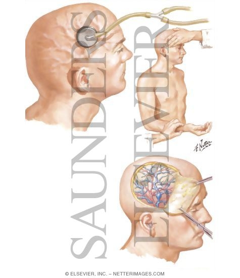 Watermarked preview of unlabeled image: Traumatic Atrioventricular Aneurysms of Scalp Vessels