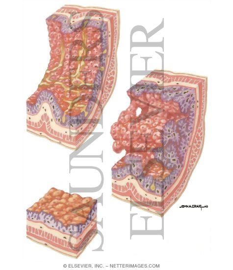Watermarked preview of unlabeled image: Inflammatory Bowel Disesae: Progression of Inflammatory Process In Ulcerative Colitis